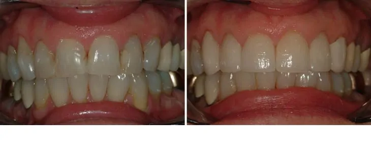 before and after dental photos - Walnut Grove Dental Group