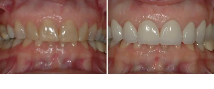 before and after dental photos - Walnut Grove Dental Group