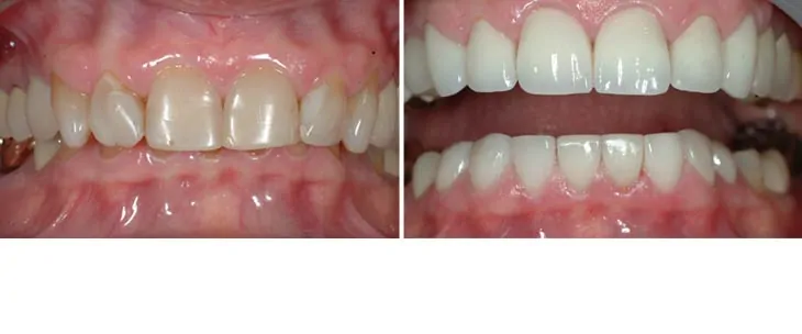 before and after dental photos - Walnut Grove Dental Group