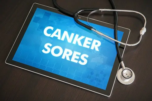 Featured image for “Canker Sore Treatment”