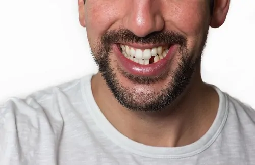 Featured image for “Your Missing Tooth is No Match For These Dental Solutions”