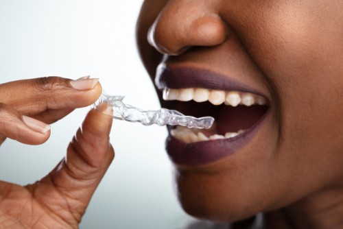 Featured image for “DIY Orthodontics: What You Need to Know”